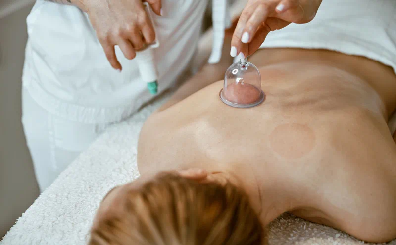 Cupping Therapy: A Secret Weapon in the Fight Against Anxiety